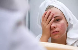 Acné sévère : un nouveau traitement réduit de 50% les symptômes