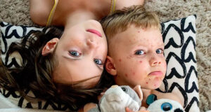 Cette maladie virale s’est fortement propagée en Europe avec 30 fois plus de cas en 2023