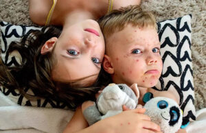 Cette maladie virale s’est fortement propagée en Europe avec 30 fois plus de cas en 2023