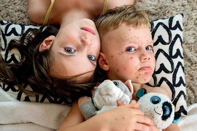 Cette maladie virale s’est fortement propagée en Europe avec 30 fois plus de cas en 2023