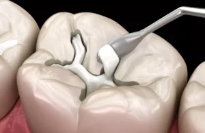 Bientôt un médicament révolutionnaire pour faire repousser les dents