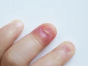 Comment reconnaître et soigner un panaris ?