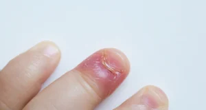 Comment reconnaître et soigner un panaris ?