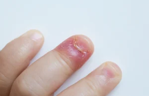 Comment reconnaître et soigner un panaris ?