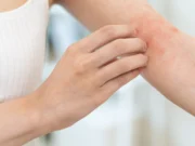 Comment reconnaître une réaction allergique cutanée ?