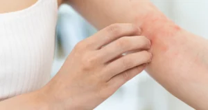 Comment reconnaître une réaction allergique cutanée ?