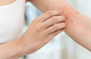 Comment reconnaître une réaction allergique cutanée ?