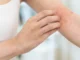 Comment reconnaître une réaction allergique cutanée ?