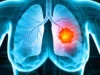 Cancer du poumon : un traitement prometteur contre les formes agressives