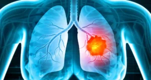 Cancer du poumon : un traitement prometteur contre les formes agressives