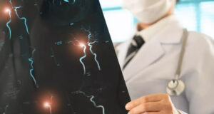 Le stress peut-il provoquer un anévrisme cérébral ?