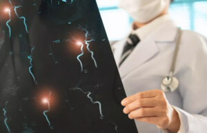 Le stress peut-il provoquer un anévrisme cérébral ?