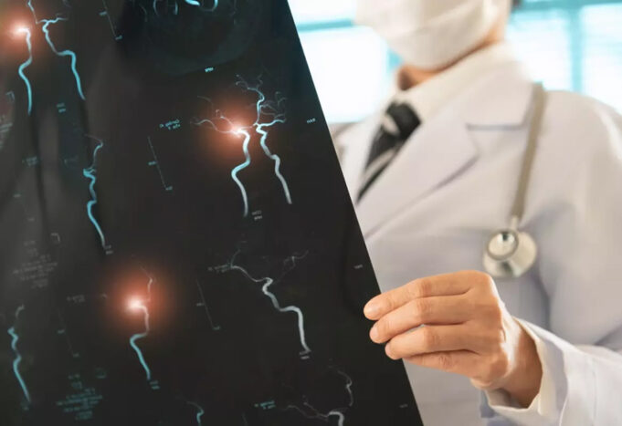 Le stress peut-il provoquer un anévrisme cérébral ?