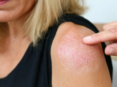 Ces médicaments très courants peuvent détruire votre peau au soleil, soyez vigilant