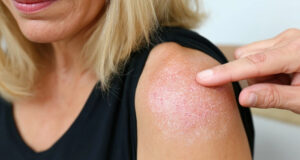 Ces médicaments très courants peuvent détruire votre peau au soleil, soyez vigilant