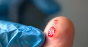 Petite coupure, grosse infection : le danger insoupçonné d’une blessure anodine