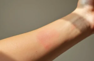 Démangeaisons mystérieuses : quand faut-il s’inquiéter vraiment