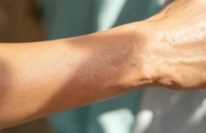 Psoriasis en plaques : découvrez comment soulager cette maladie invisible