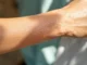 Psoriasis en plaques : découvrez comment soulager cette maladie invisible