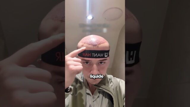 Sa Tête A Gonflé Après Sa Greffe De Cheveux