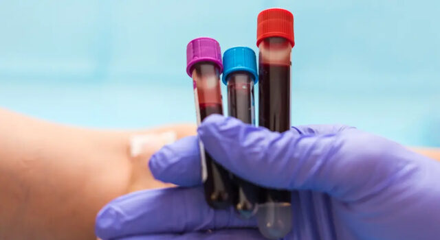 Ce groupe sanguin fait vieillir le cerveau plus vite : 2,7 millions de Français concernés