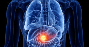 Espoir majeur dans le cancer du pancréas : un nouveau traitement double la survie des patients à un an