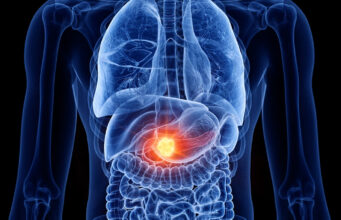 Espoir majeur dans le cancer du pancréas : un nouveau traitement double la survie des patients à un an