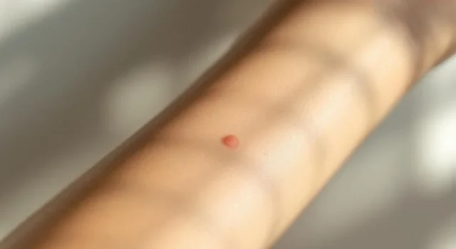 Tache sur la peau : quand alerter pour éviter le cancer