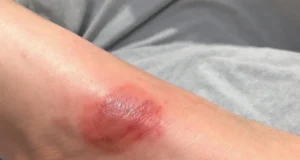 Ulcères de jambes : le danger méconnu qui menace votre santé