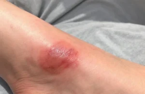 Ulcères de jambes : le danger méconnu qui menace votre santé