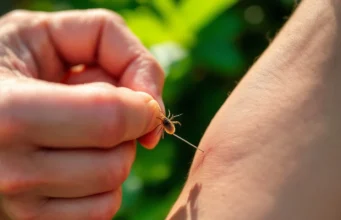 Attention aux astuces risquées pour retirer une tique cet été