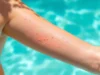 Boutons de chaleur en été : comment les reconnaître et les soigner rapidement