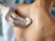 Kyste pilonidal : comment soulager la douleur et éviter l’opération