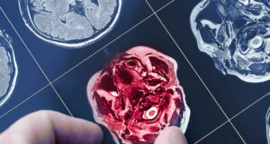 Ces stars touchées par la maladie d’Alzheimer