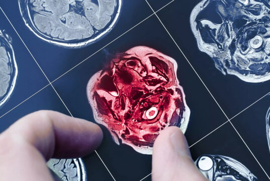 Ces stars touchées par la maladie d’Alzheimer