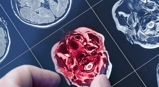 Ces stars touchées par la maladie d’Alzheimer