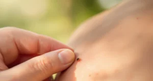 Tique: combien de temps pour la retirer et éviter le danger