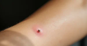 Pourquoi certaines piqûres de moustiques gonflent plus que d’autres ?