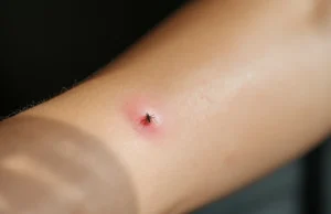 Pourquoi certaines piqûres de moustiques gonflent plus que d’autres ?